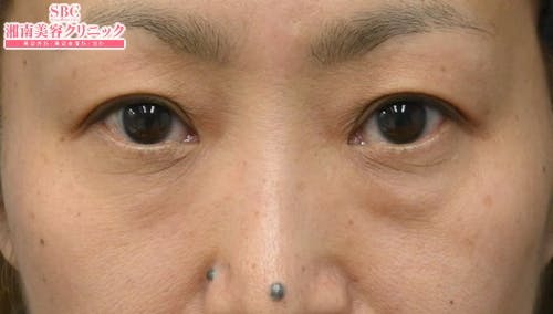 【40代女性・目元】目の下の切らないクマ・たるみ（ふくらみ）取り ナチュラル脂肪注射コンデンスリッチ ナチュラル脂肪注射ナノリッチ_before