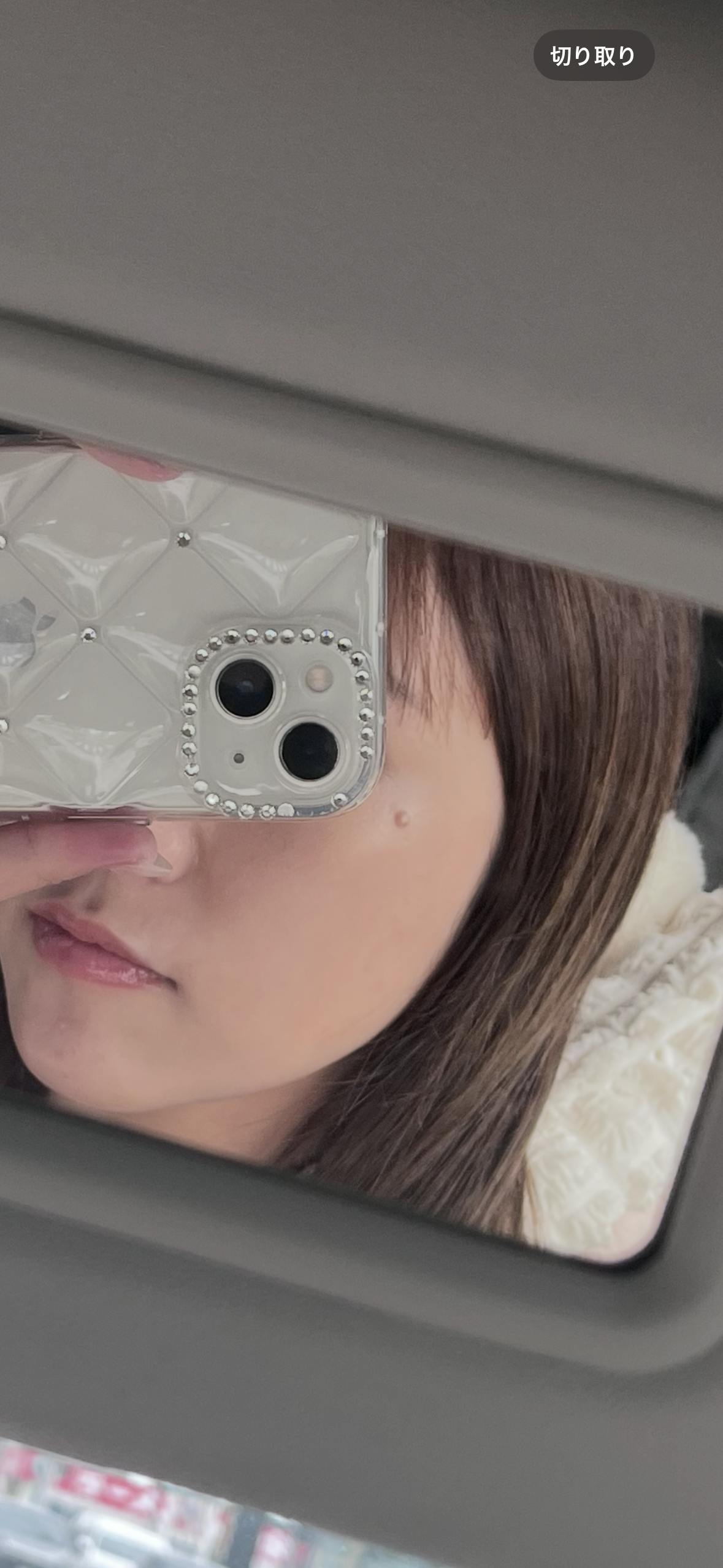 蘇春堂形成外科でホクロ除去を受けたelleriさんの写真