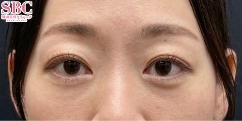 【女性・目元】目の下の切らないクマ・たるみ（ふくらみ）取り ナチュラル脂肪注射コンデンスリッチ ナチュラル脂肪注射ナノリッチ_after