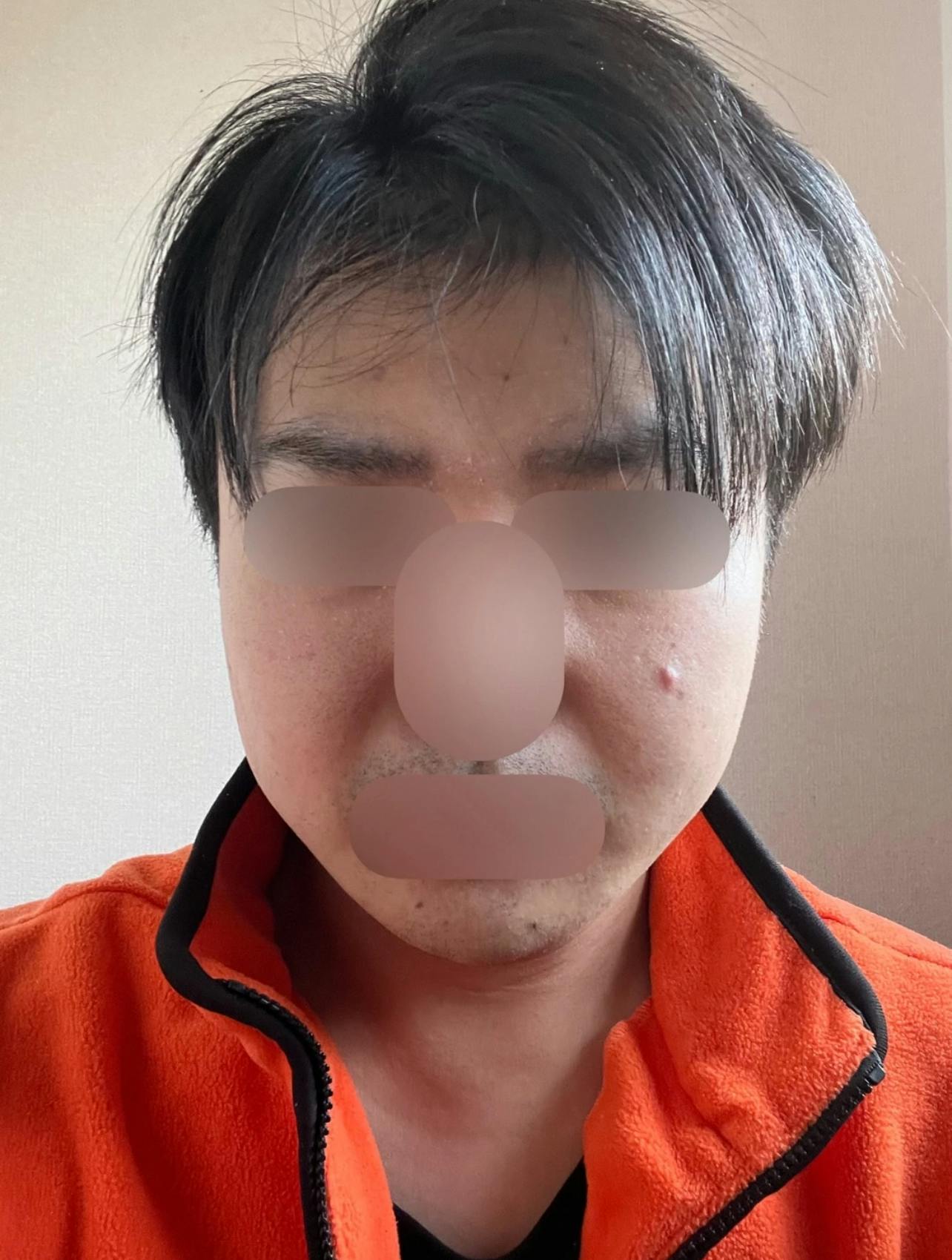 城本クリニック 岐阜院で美容点滴・注射を受けたざわしさんの写真