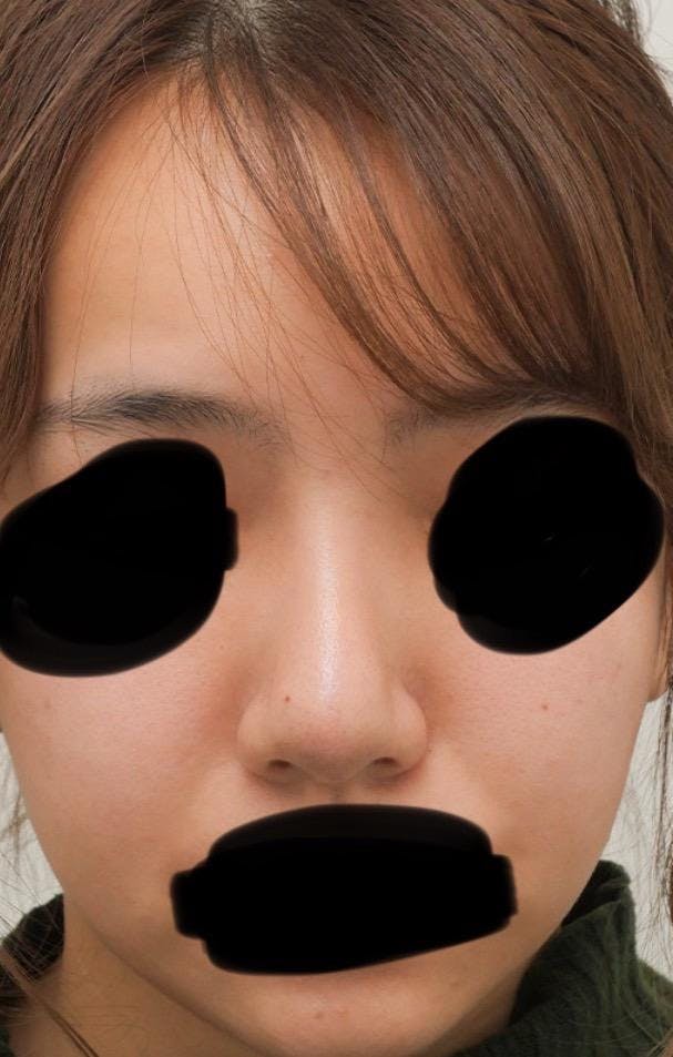 東京イセアクリニック(TOKYO ISEA CLINIC)で鼻の整形：プロテーゼによる隆鼻術を受けたSACCHYさんの写真