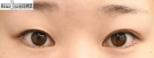 【22歳女性・目元】グランドループ法_before