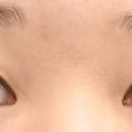 【22歳女性・目元】グランドループ法_before