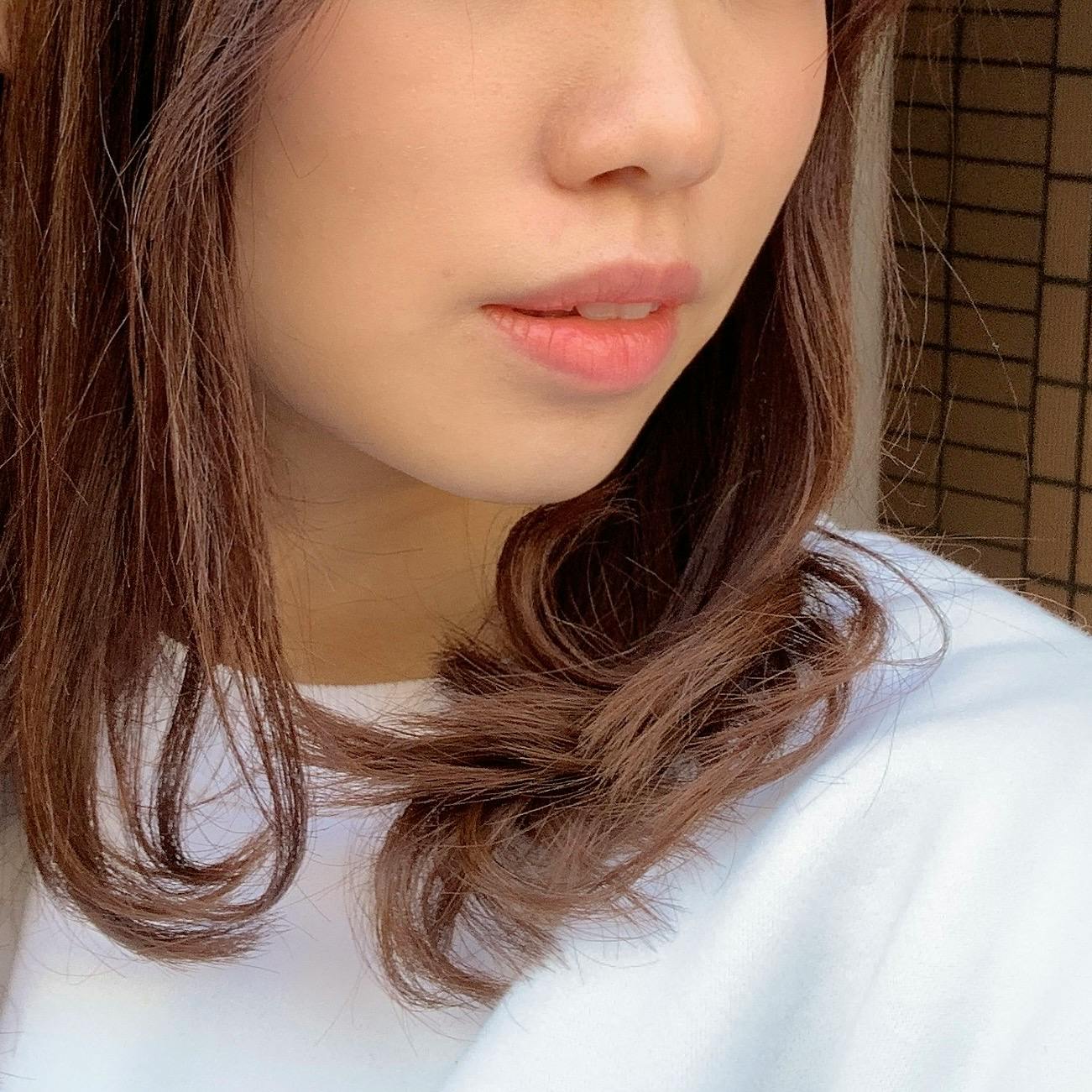 品川美容外科 横浜院（※品川スキンクリニック提携）でを受けたminaさんの写真