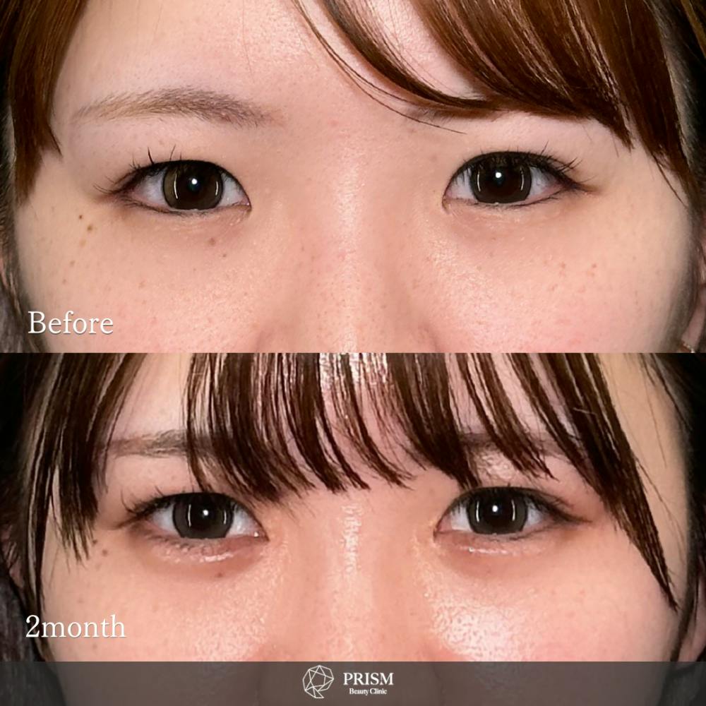 【20代女性・目】目頭切開Z法_before_aftar