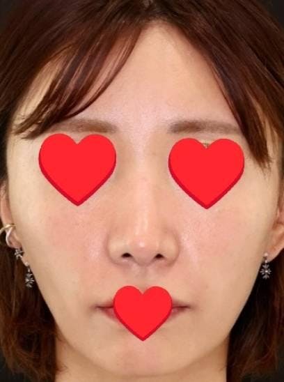 オーロラクリニック 新宿院(AURORA CLINIC)で注入治療：頬のヒアルロン酸（ボリューマXC）を受けたMACOさんの写真