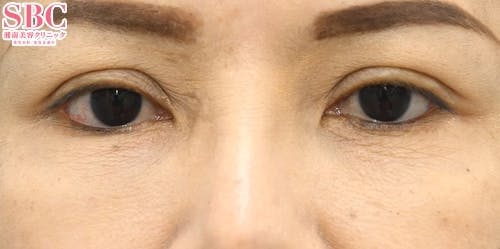 【40代女性・シワ】リジュランi_before