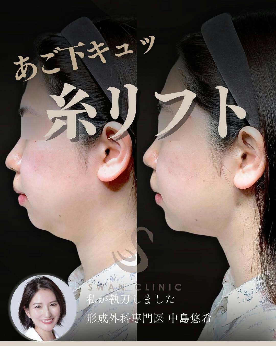 【女性・顎下】糸リフト 顎ヒアルロン酸注入_before_aftar