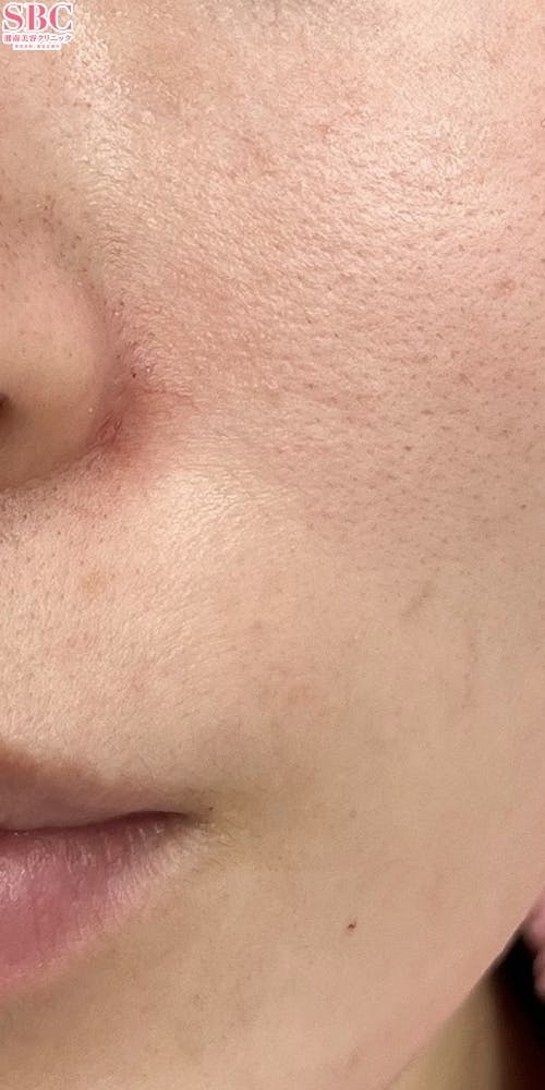 【女性・ほうれい線】ヒアルロン酸ジュビダームビスタ ウルトラプラスXC_after