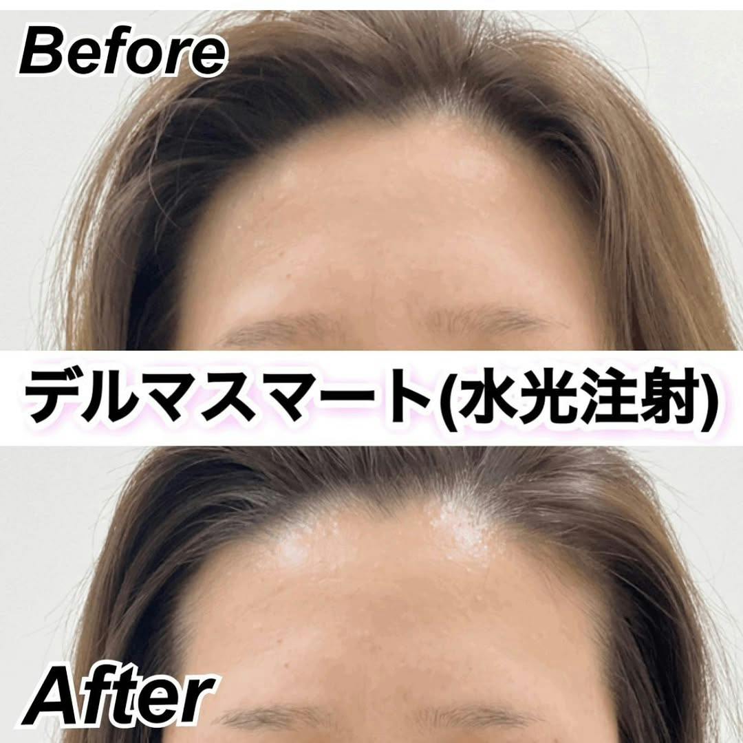 【女性・ハリ】デルマスマート_before_aftar