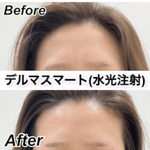 【女性・ハリ】デルマスマート_before_aftar