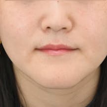 【女性・ほうれい線】VOV(ボブ)リフト、ヒアルロン酸_after