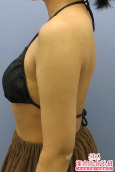 【女性・腕】ライポマティック脂肪吸引・根こそぎVASER脂肪吸引_aftar