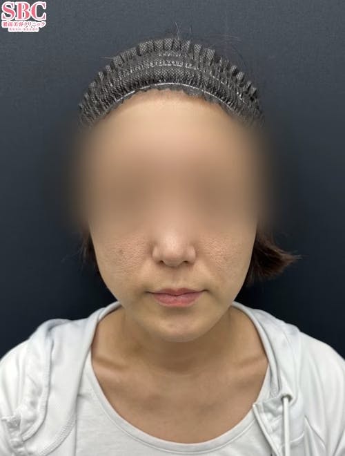 【30代女性・たるみ】シークレットリフト_before