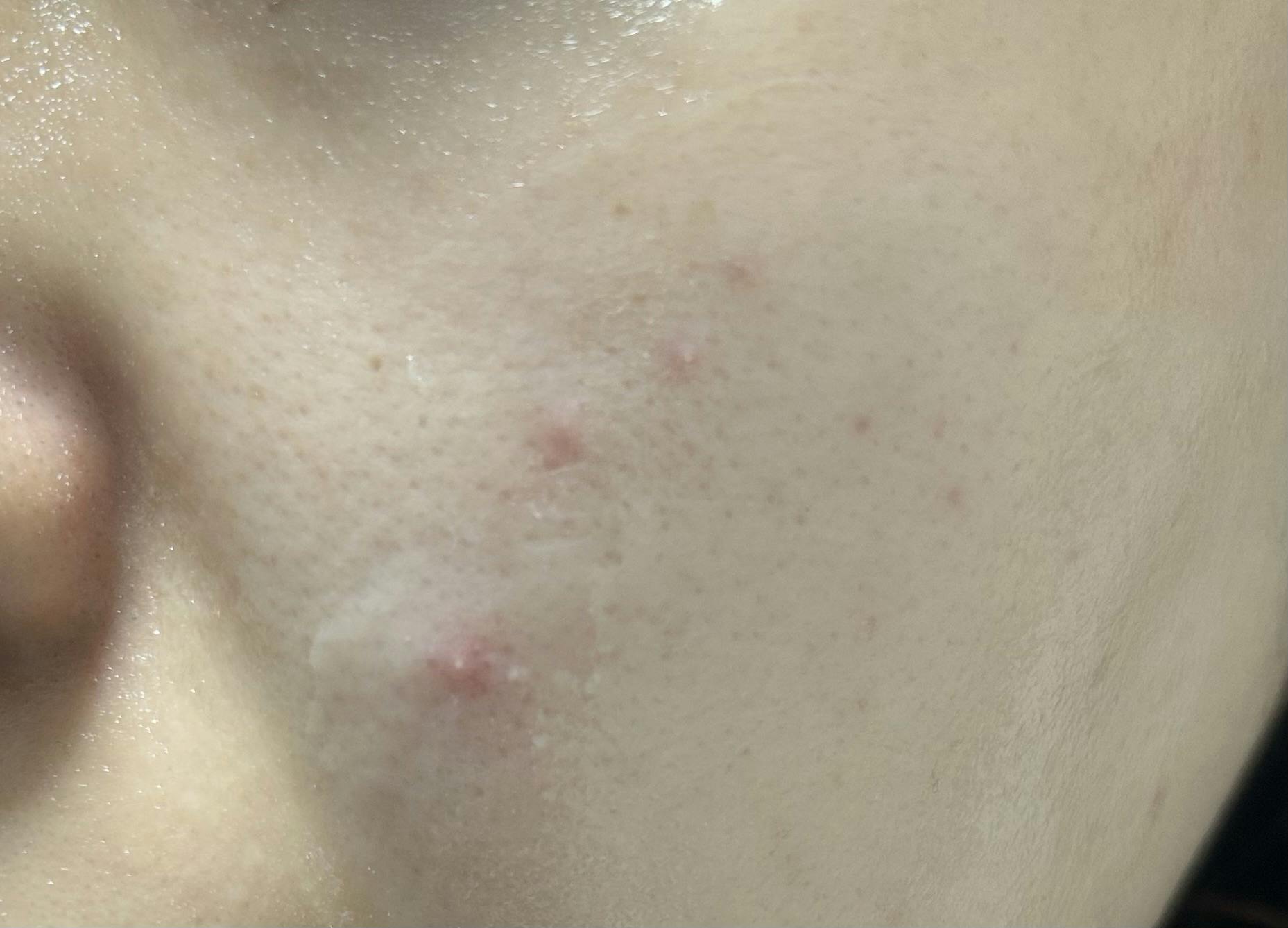 ソワカウィメンズヘルスクリニック(sowaka women’s health clinic)でヴェルベットスキンを受けたTiさんの写真