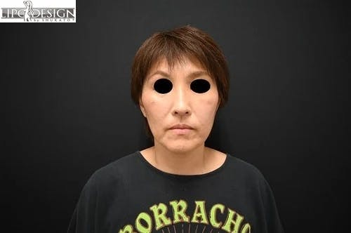 【49歳女性・輪郭】SBCプレミアムPRP皮膚再生療法_after