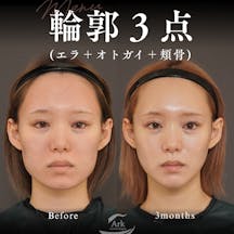 【20代女性・輪郭】輪郭3点(エラ+オトガイ+頬骨)、外板除去_before_aftar