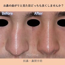 【男性・鼻】斜鼻・鼻閉手術_before_aftar