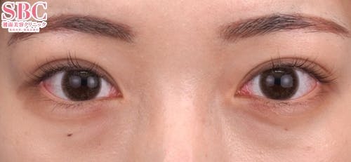 【20代女性・目元】クイックコスメティーク・トリプルNeo_after