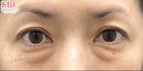 【50代女性・クマ】裏ハムラ法 ナチュラル脂肪注射ナノリッチ_before