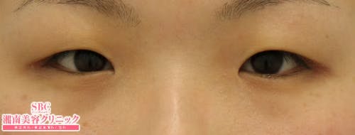 【女性・目元】全切開法二重術、目頭切開プレミアム_before
