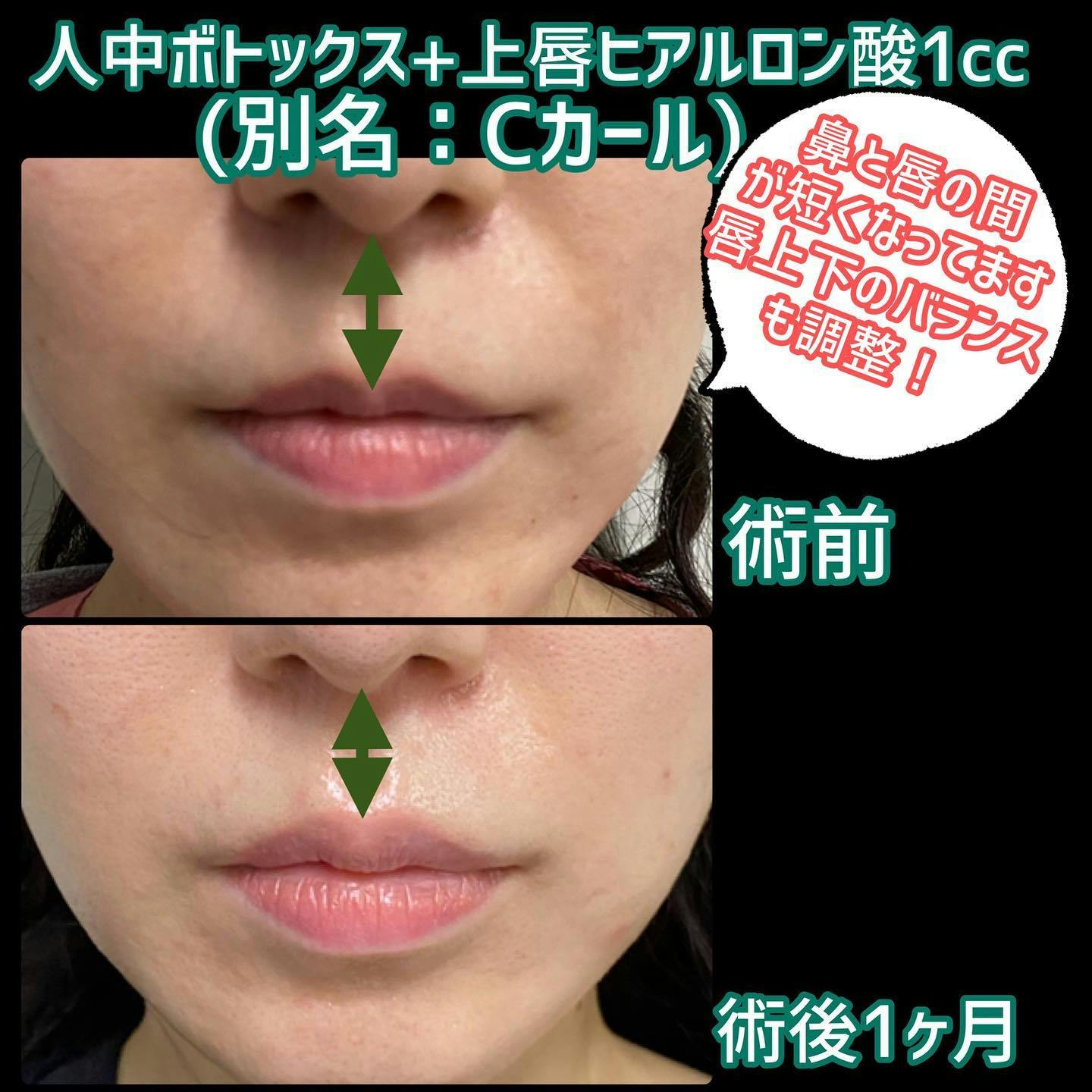 【女性・人中】人中ボトックス＋上唇ヒアルロン酸（別名: Cカール）_before_aftar