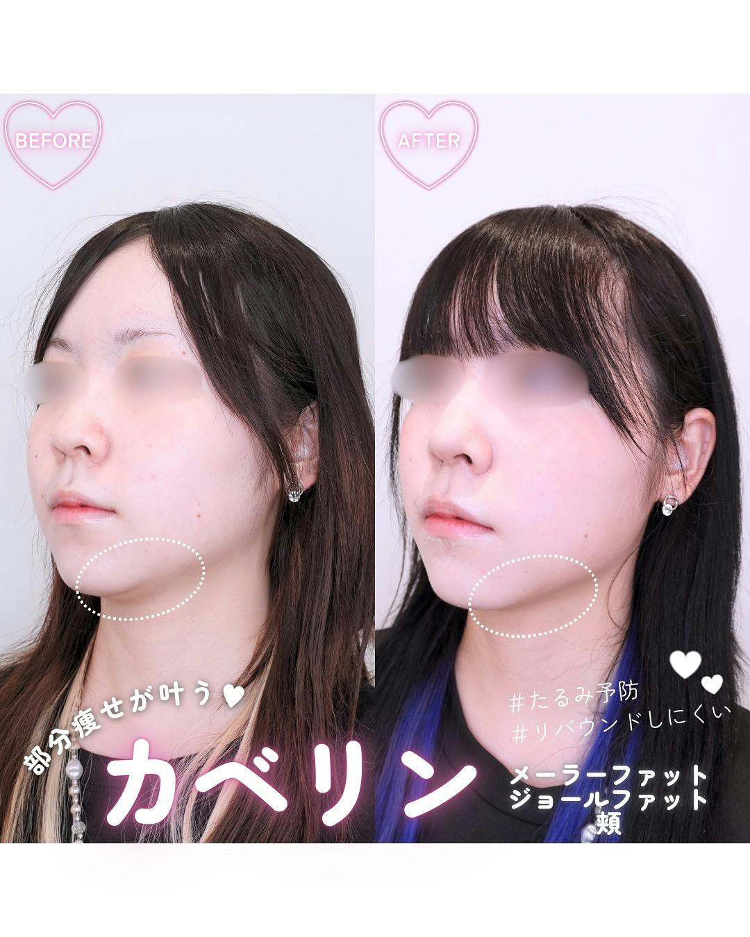 【女性・顔】カベリン メーラーファット・ジョールファット・頬_before_aftar