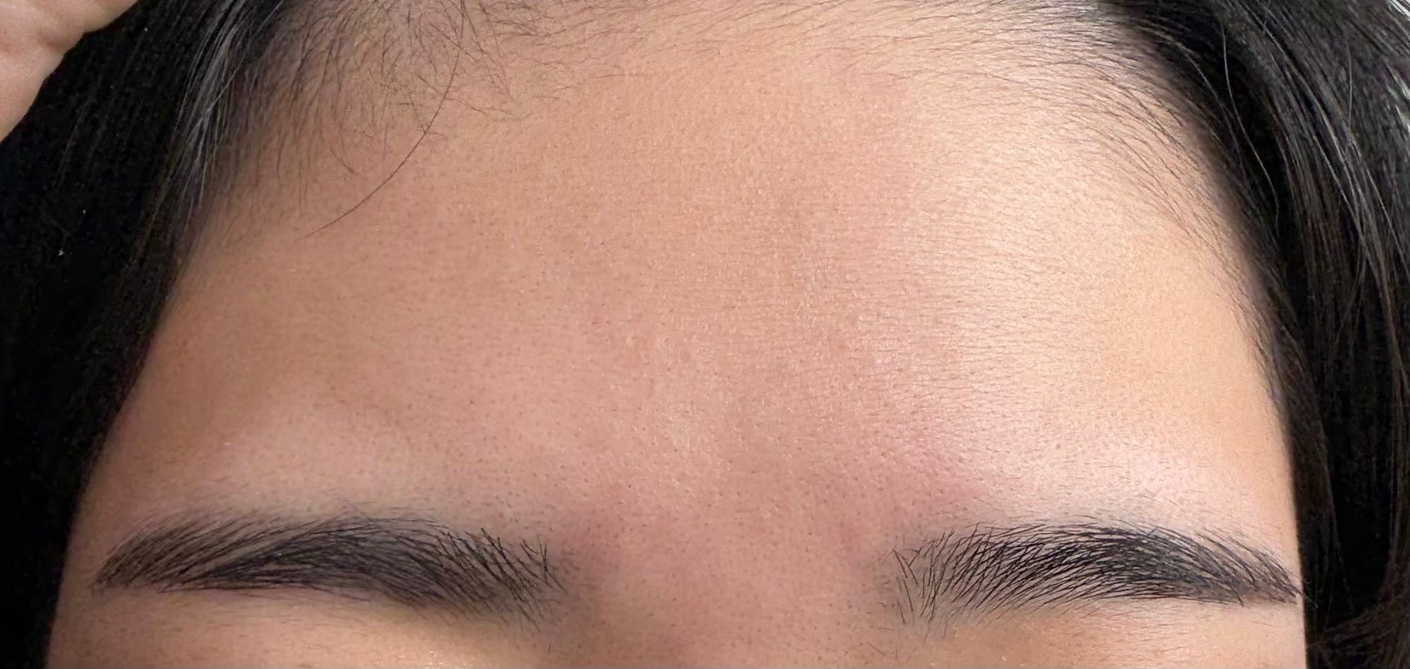 ビューティースキンクリニック 新宿院でを受けたさいさんの写真