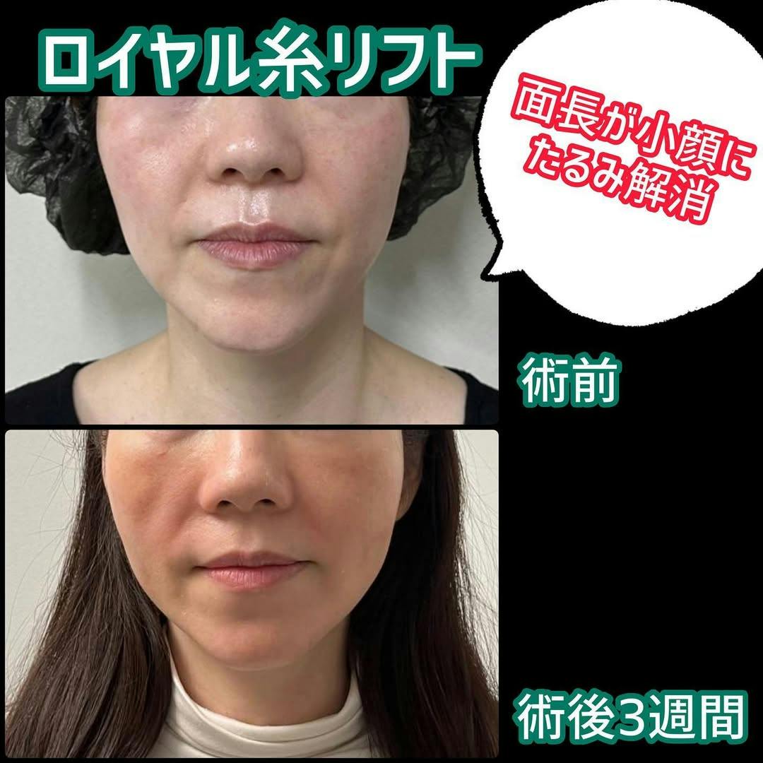 【女性・小顔】ロイヤルリフト（糸リフト）_before_aftar