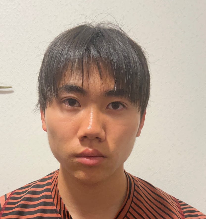 TCB東京中央美容外科 静岡院でボトックス注射・エラボトックス注射(小顔)・韓国製ボトックス・ボツリヌストキシンを受けたmさんの写真