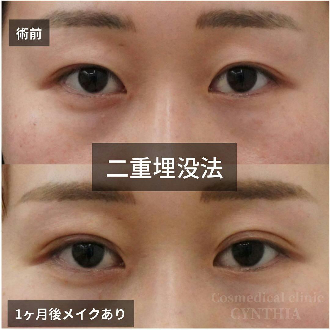 【20代女性・目元】二重埋没法_before_aftar