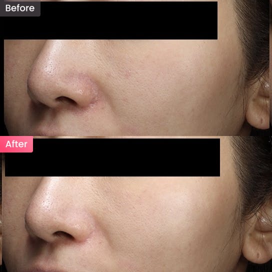 【女性・毛穴】毛穴が気になるの写真