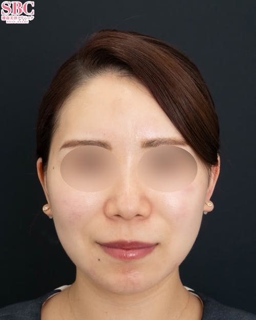 【20代女性・顔】Aquicell（アキーセル）脂肪吸引、根こそぎVASER脂肪吸引、ボトックス、SBCプリマリフト_before