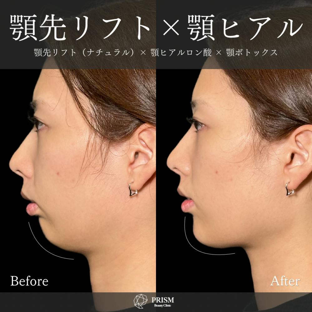 【20代女性・顎】あご先リフト＋ ヒアルロン酸（顎）_before_aftar
