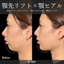 【20代女性・顎】あご先リフト+ ヒアルロン酸(顎)_before_aftar