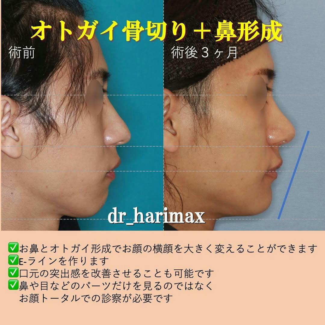 【男性・顎・鼻】オトガイ骨切り・鼻骨骨切り・鼻尖形成・鷲鼻削り_before_aftar