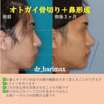 【男性・顎・鼻】オトガイ骨切り・鼻骨骨切り・鼻尖形成・鷲鼻削り_before_aftar