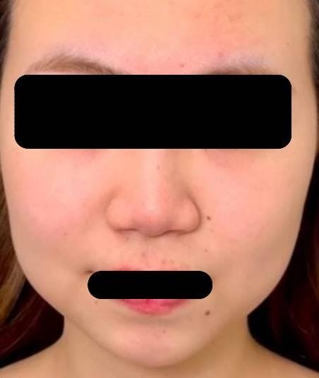 湘南美容クリニック 新橋銀座口院で鼻整形：小鼻縮小術（鼻翼縮小）を受けたウィンさんの写真