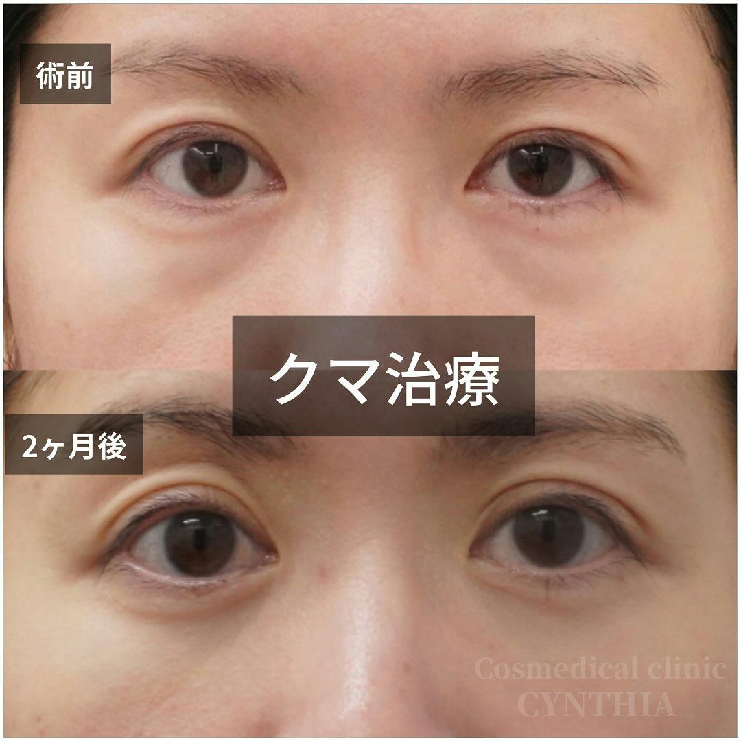 【女性・目元】目の下のクマ取り_before_aftar