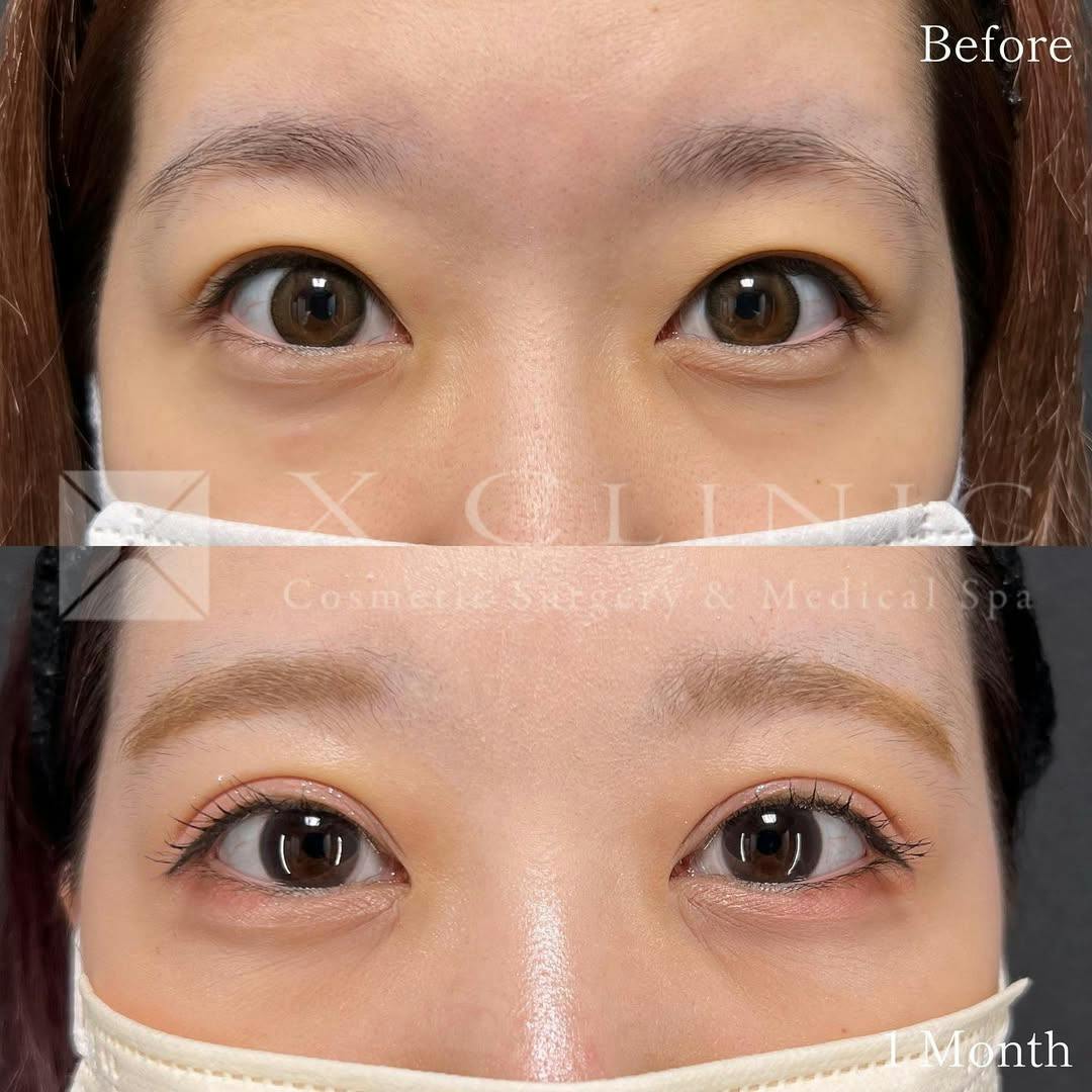 【20代女性・目元】Xクロスダブル_before_aftar