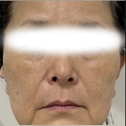 【60代女性・ほうれい線】ヒアルロン酸_a1