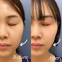 【女性・輪郭】エラボトックス_before_aftar