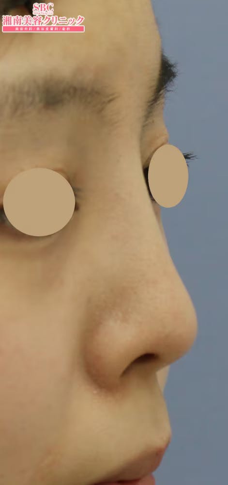 【女性・鼻】SBCプレミアムソフトプロテーゼ_aftar