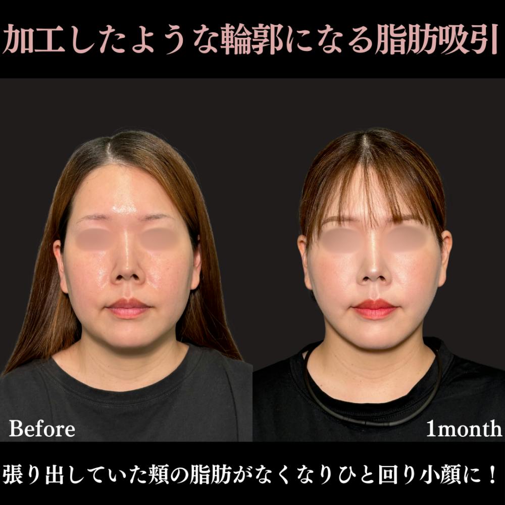 【20代女性・顔】脂肪吸引（頬・顎下）＋ グランリフト_before_aftar