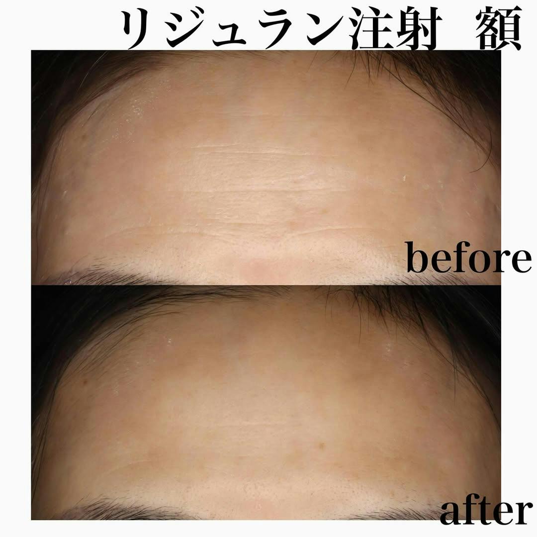 【女性・額】リジュラン注射・額_before_aftar