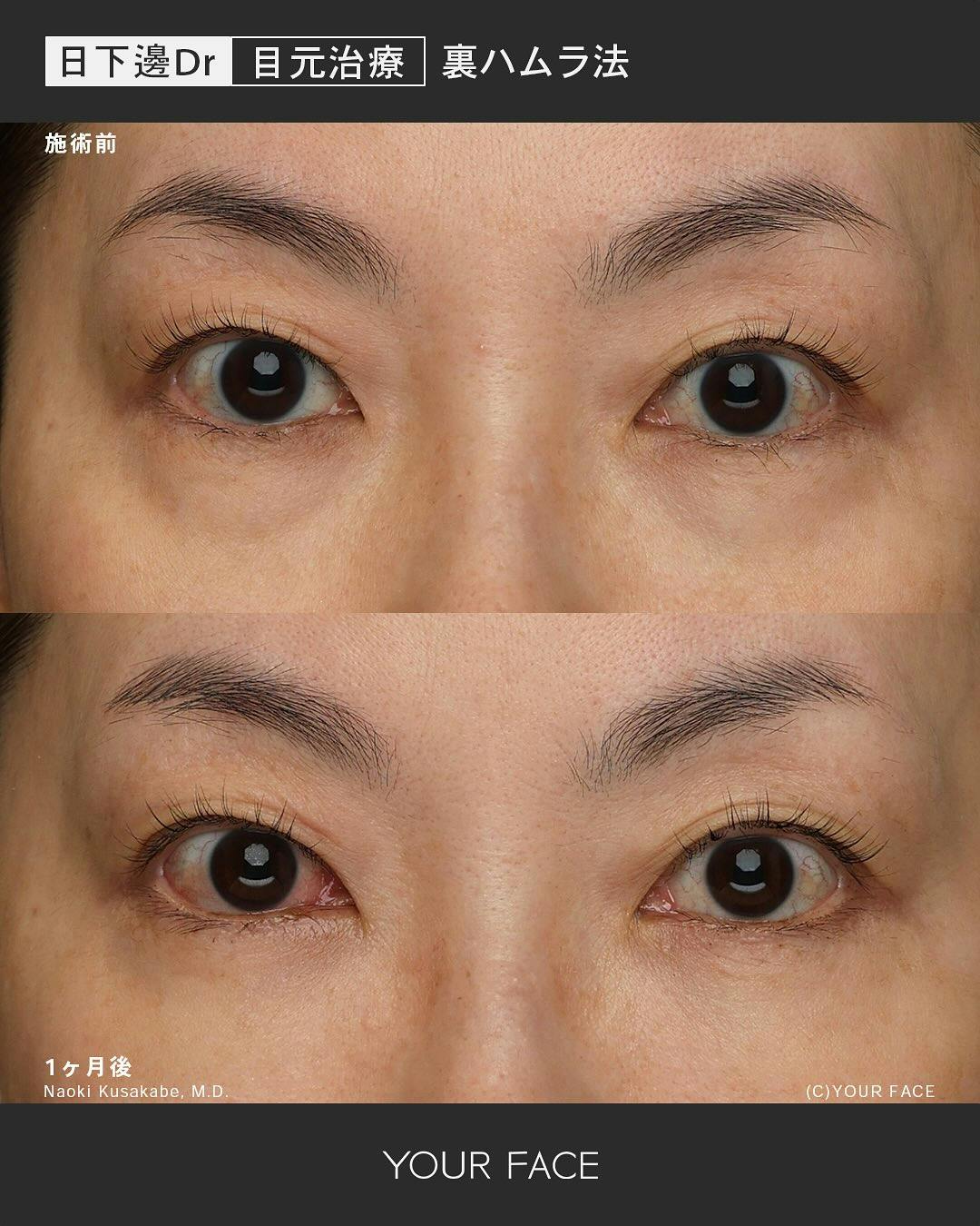 【女性・目元】裏ハムラ法_before_aftar