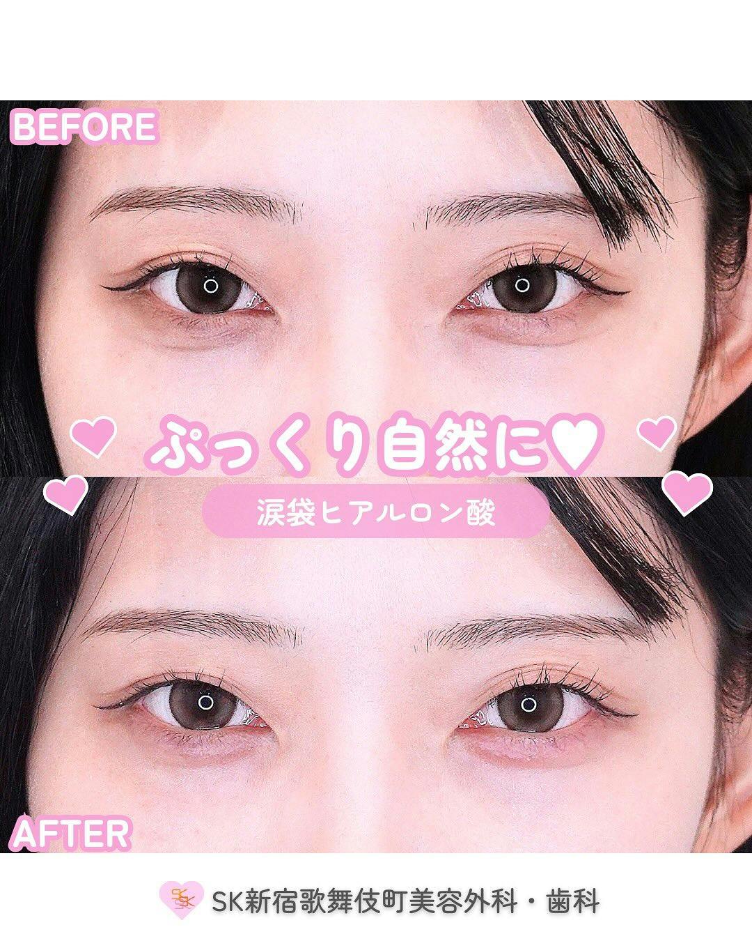 【女性・目元】涙袋ヒアルロン酸_before_aftar