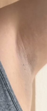 大西皮フ科形成外科医院 滋賀大津石山院でを受けたのりんちゅさんの写真