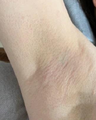 美容皮膚科エルムクリニック 福岡院で医療レーザー脱毛：全身脱毛 + VIOを受けたもにちゃんさんの写真