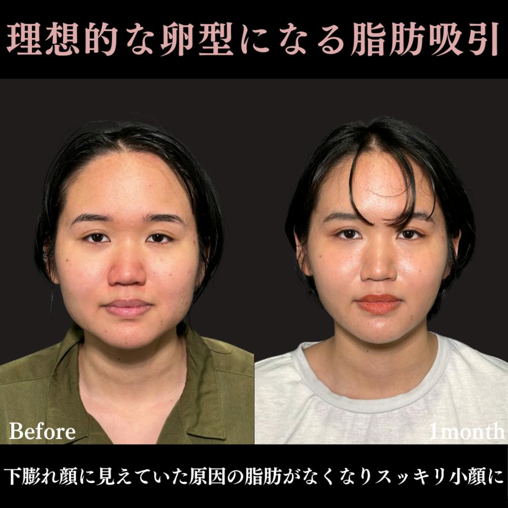 【20代女性・顔】脂肪吸引プレミアム（頬） ＋ エラボトックス_before_aftar